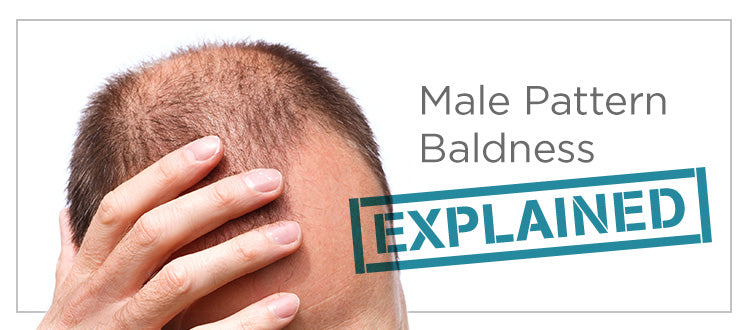 Male Pattern Baldness Explained