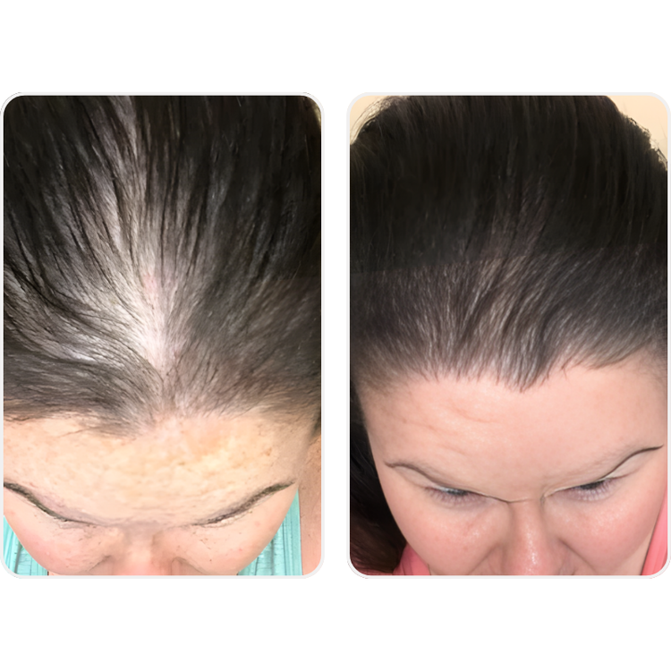 Before and after results from Kristin, a Viviscal Professional user in her 50s